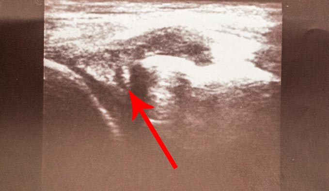 The ultrasound indicating a torn meniscus on the medial side.